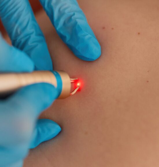 Skin Tag Remova;