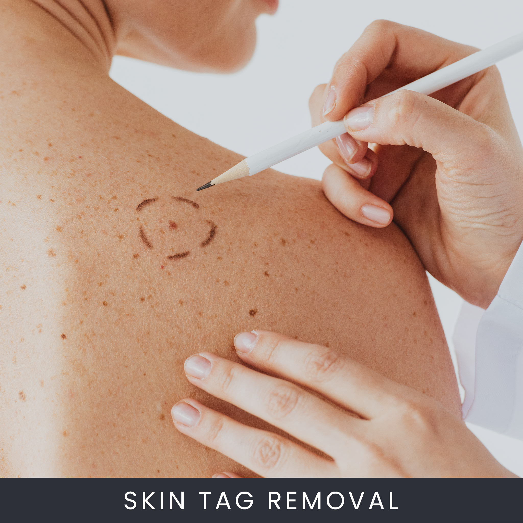 Skin Tag Removal