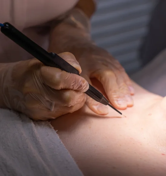 Skin Tag Removal