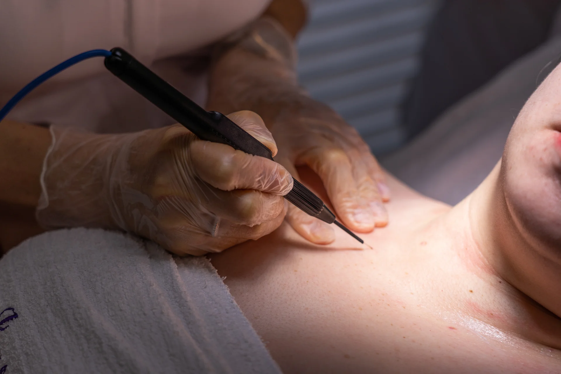 Laser Treatment 