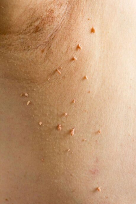 SKIN TAG REMOVAL