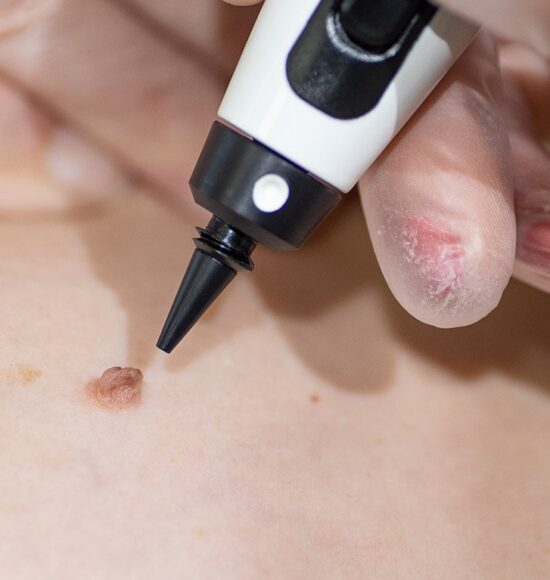 Skin Tag Removal