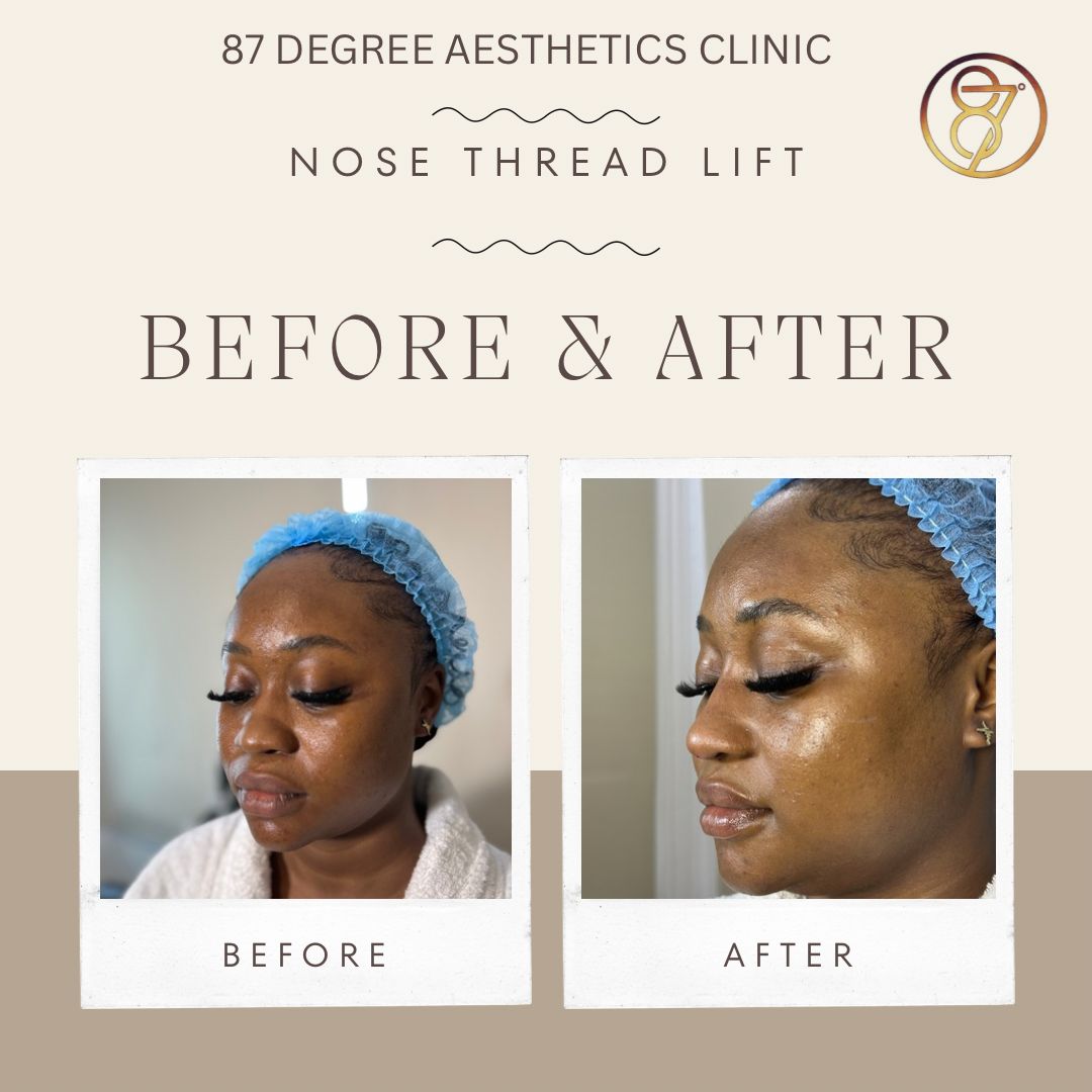 Nose Thread Lift