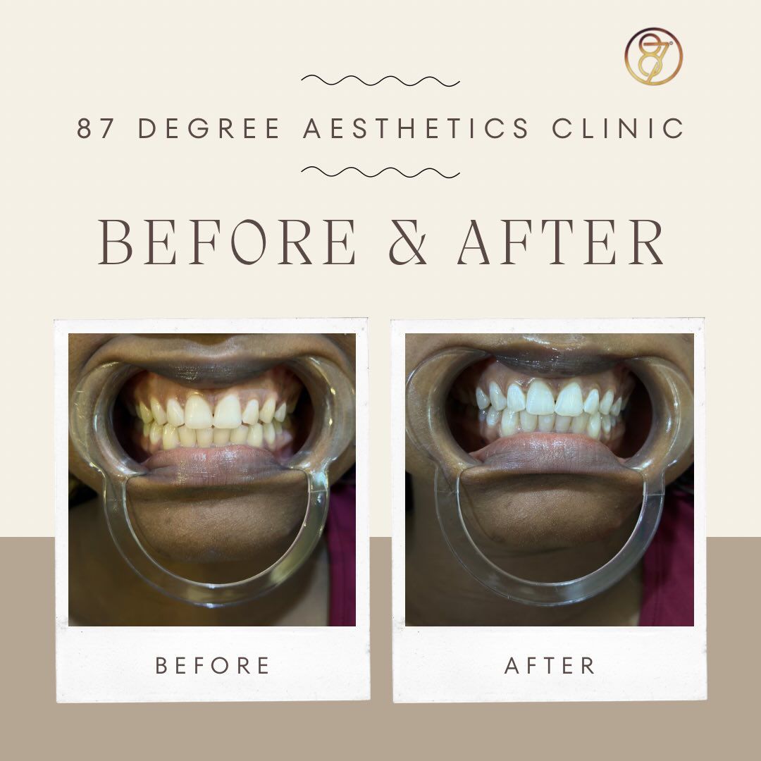 Professional Teeth Whitening That Delivers Real Results