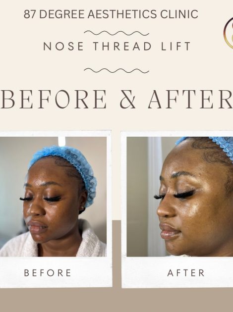 Nose Thread Lift